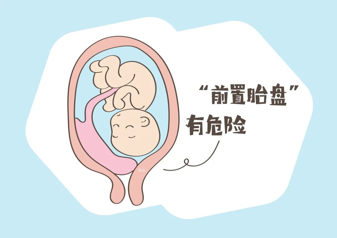 检出“前置胎盘”有危险，孕妈要警惕3种行为，可有效预防问题发生！