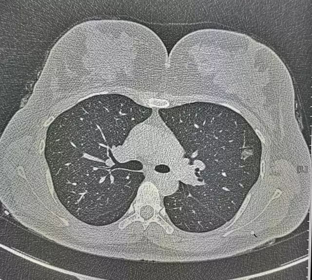 29岁姑娘查出肺结节肺腺癌！医生却说幸亏她得了另外一种病！