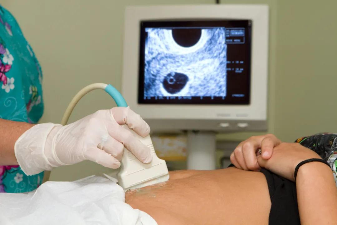 多囊卵巢综合征，什么时候可以促排卵？