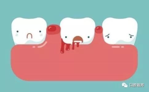 6种简单的方法来阻止牙龈出血