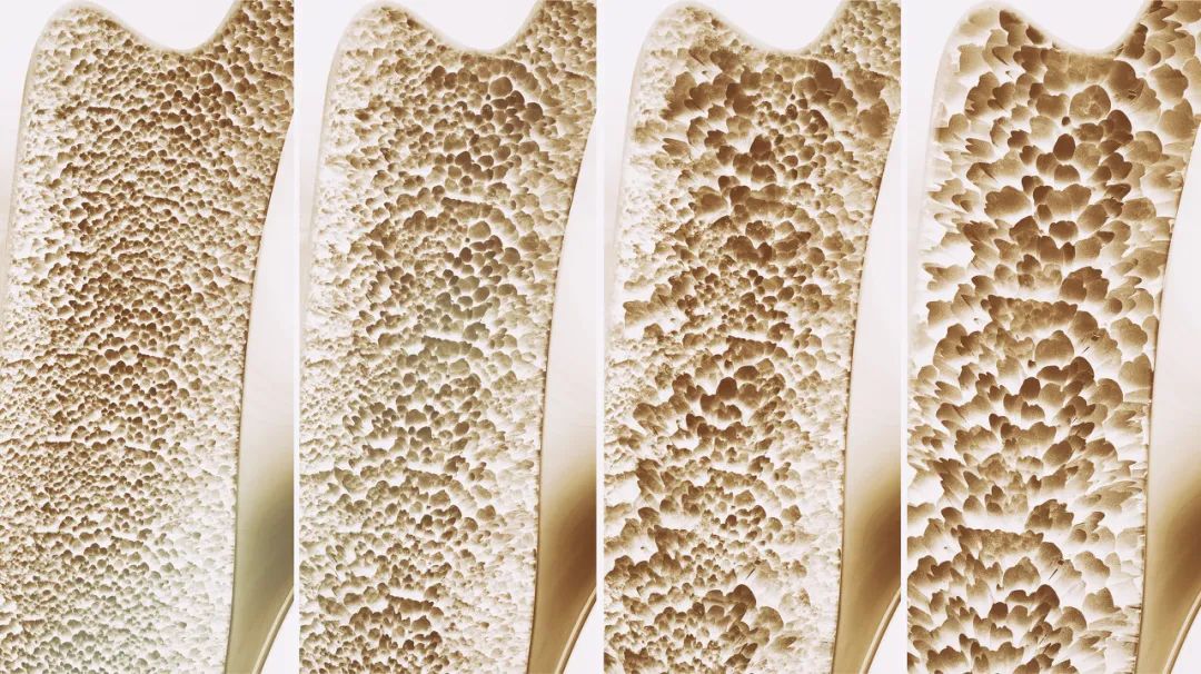 小腿“抽筋”就是缺钙？还有可能预示着这些疾病！