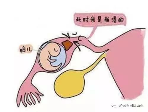 子宫纵膈能做试管婴儿怀上吗？3分钟带你全面了解子宫纵膈！