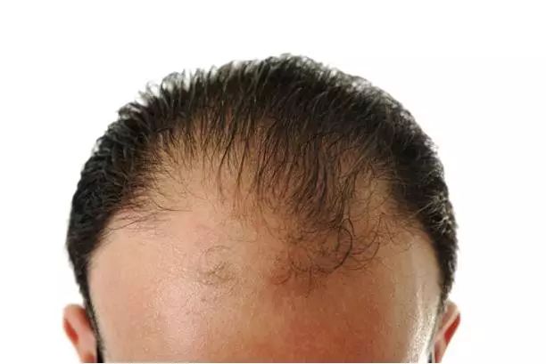 逆转脱发！高脂饮食是脱发元凶，新研究可让毛发恢复如初