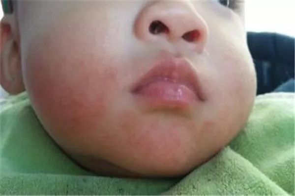 小宝宝严重流口水，如何辨别生理和病理很重要！月嫂又该如何护理口水疹呢？