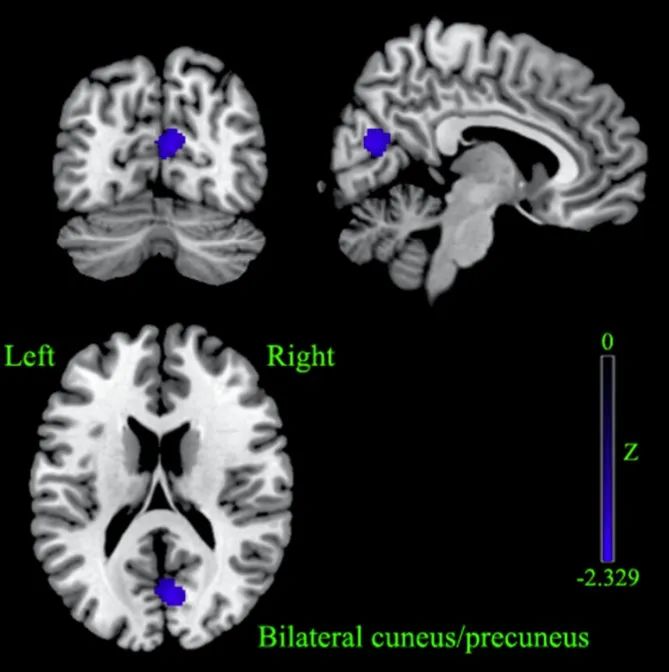 佳文有约|遗忘型轻度认知功能障碍的低频脑活动异常：一项静息态功能磁共振研究的meta分析