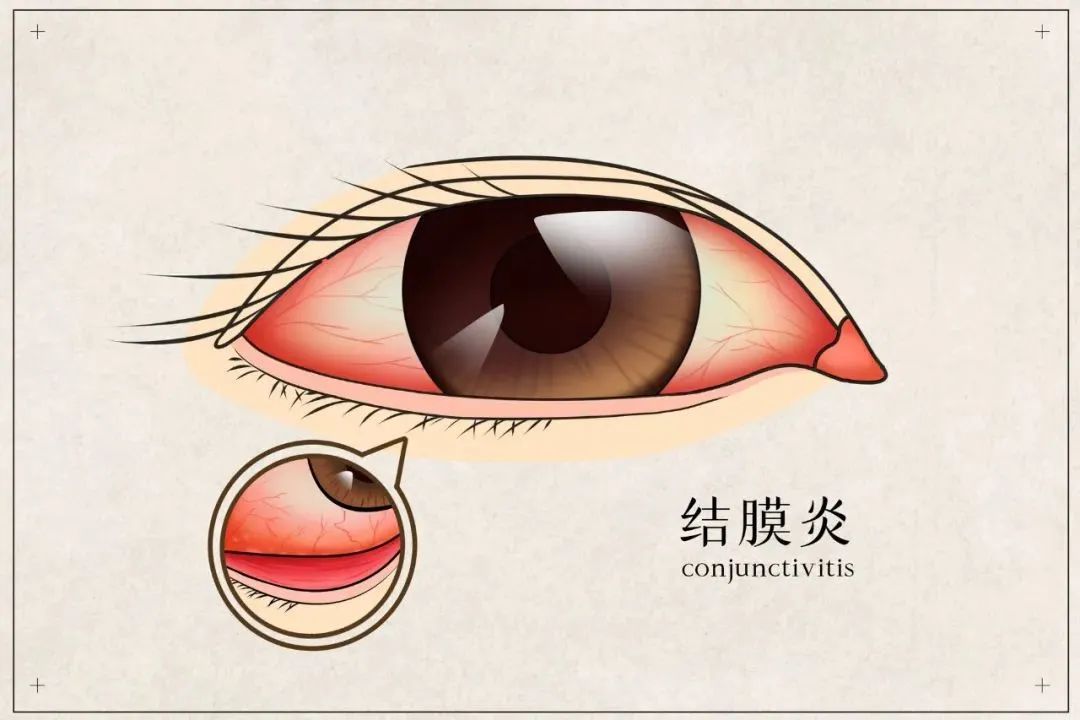 “红眼病”看一眼就会被传染？预防红眼病做好这几