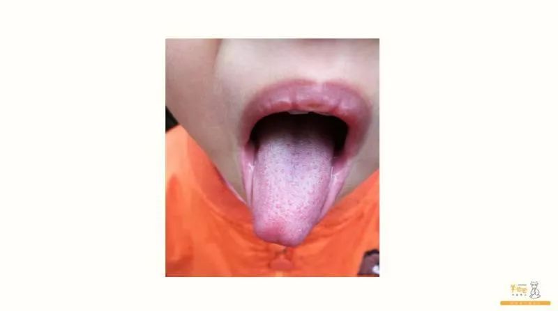 病案 | 6岁孩子发烧后小便减少出现..分泌物