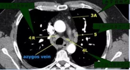 这些容易误判的胸部CT“病变”，你都见过吗？