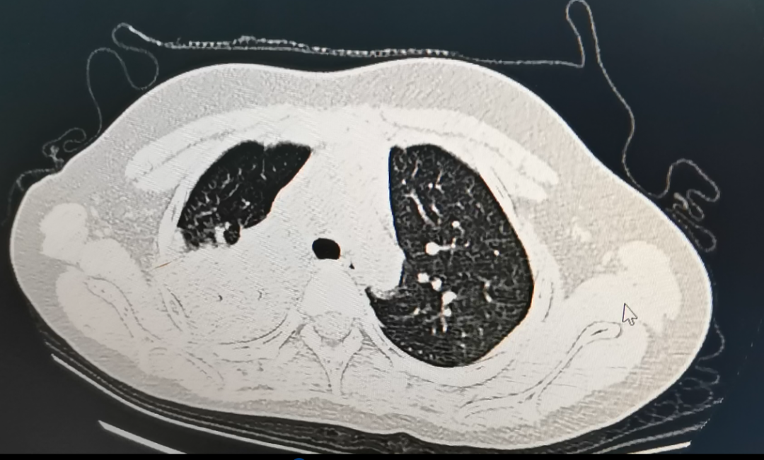 下月或达感染高峰，一地疾控紧急提醒！这两种药完全无效